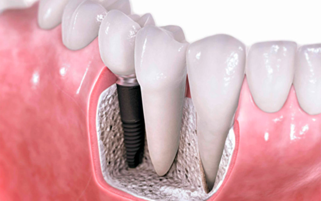 implante de dientes