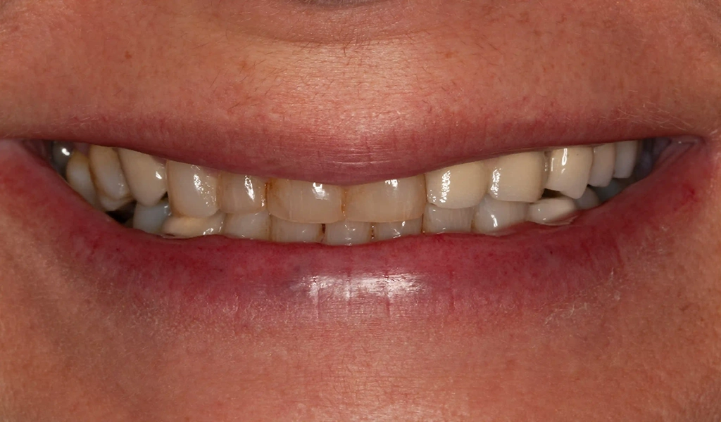Estado inicial antes del tratamiento dental
