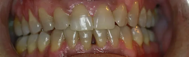 CARILLAS DE COMPOSITE COMO SOLUCIÓN AL PACIENTE TETRACICLÍNICO