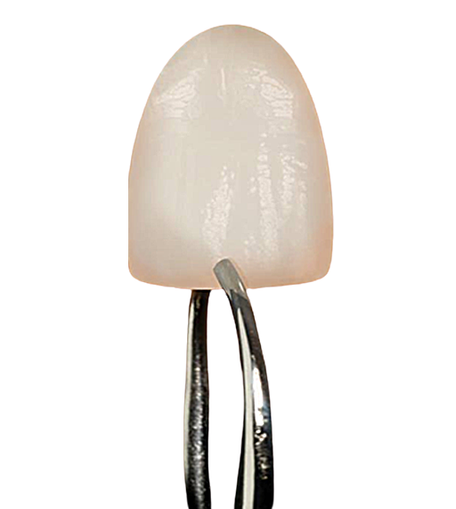 Comparativa grosor carilla Lumineers 0.3mm vs carilla tradicional