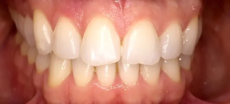 BLANQUEAMIENTO DENTAL MITOS Y VERDADES