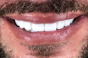 Final-sonrisa-5-1