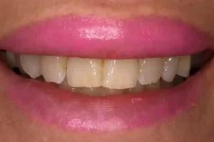 Estado inicial antes del tratamiento dental