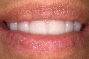 sonrisa despues