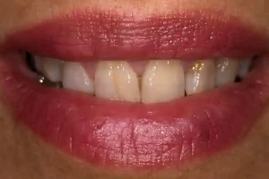 sonrisa inicial