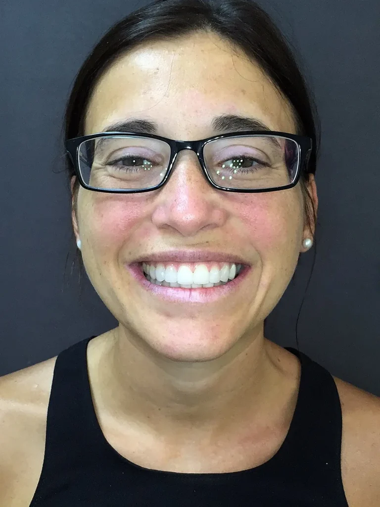 Resultado tratamiento dental Lumineers Sevilla