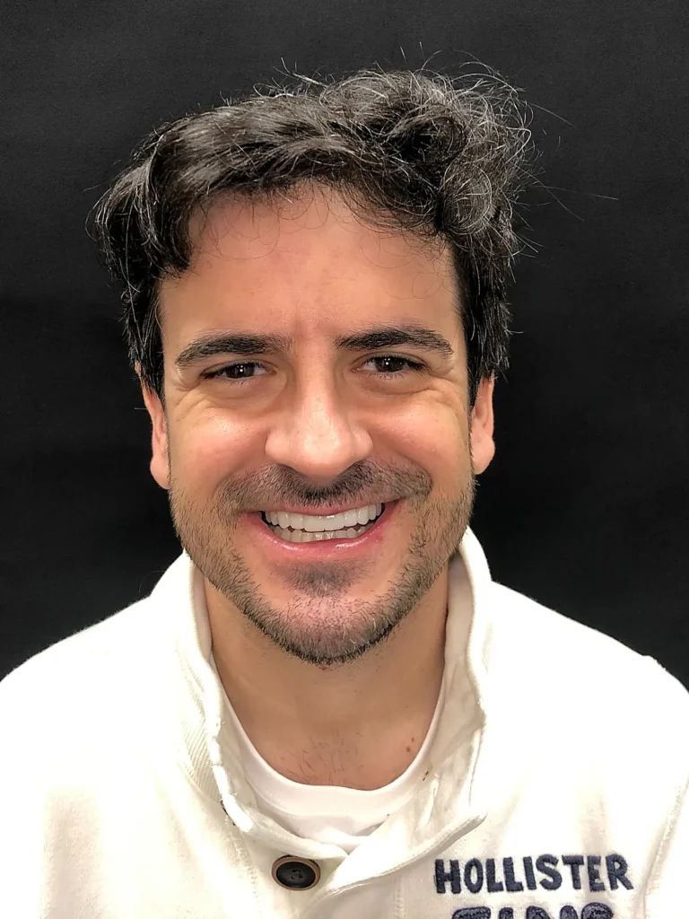 Resultado tratamiento dental Lumineers Sevilla