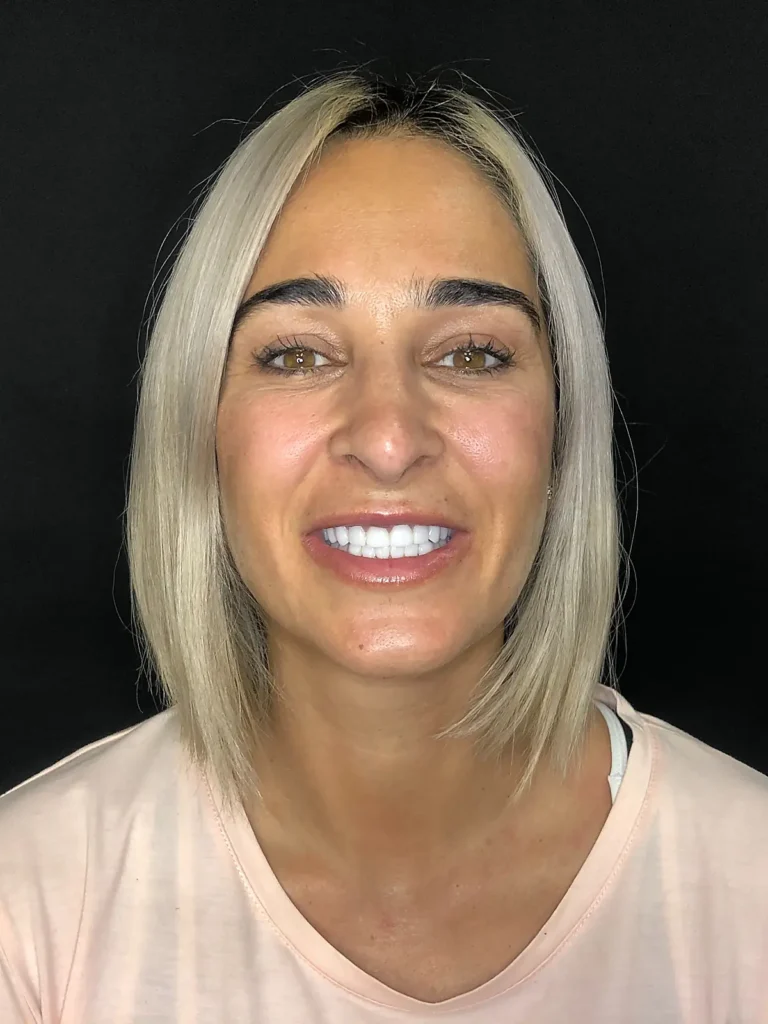 Resultado tratamiento dental Lumineers Sevilla