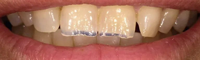 ¿SABES POR QUÉ SE DESGASTAN LOS DIENTES? ¿QUÉ PODEMOS HACER AL RESPECTO?
